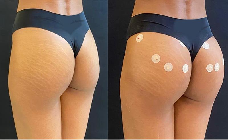 notícia PMMA: Saiba as indicações, benefícios e por que a substância é segura