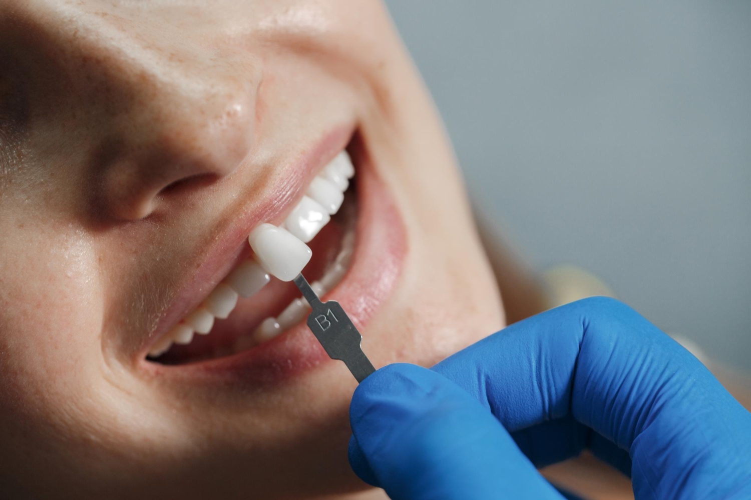 notícia Facetas de porcelana: tendência nos consultórios de Moema