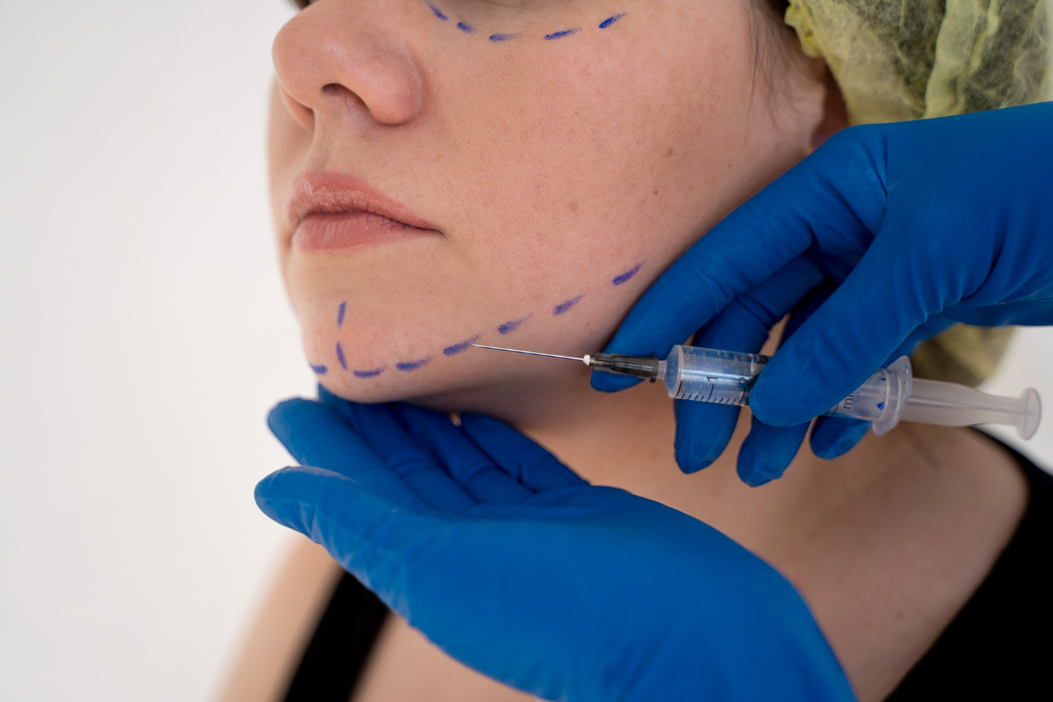 notícia Botox em Santo André: o que esperar da primeira aplicação