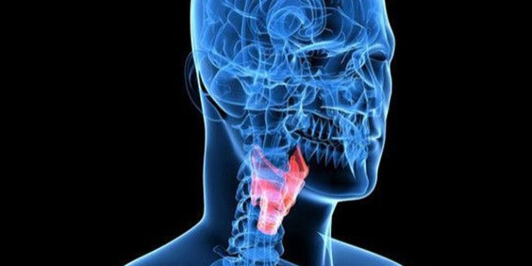 notícia O que é Tumor Orofaringe?