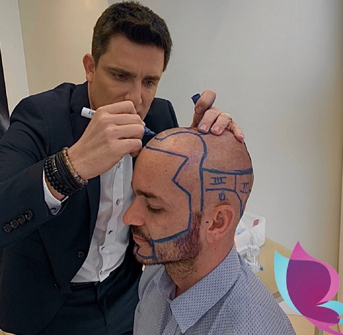 notícia Transplante Capilar FUE: Clínica Harmonia, do Dr. Carmelo Occhipinti Filho, é referência nacional em recuperação dos cabelos