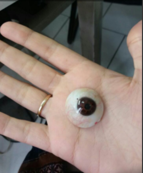 notícia Bem-estar # LENTE ESCLERAL: uma nova expectativa de vida - por Jeiane Costa*