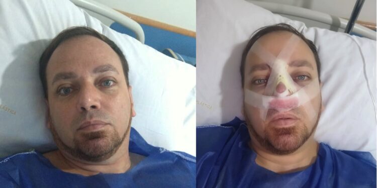 notícia Leandro Amorim faz rinoplastia e fica satisfeito com resultado