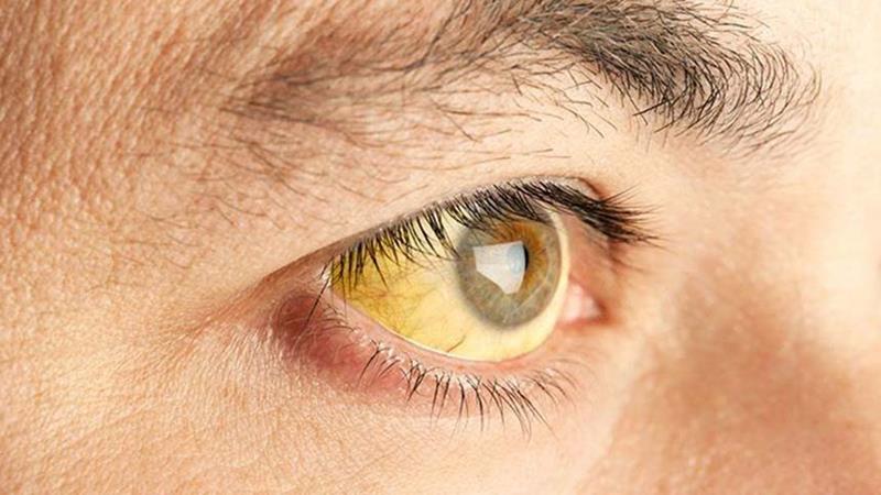 notícia Hepatite: especialista explica sobre a gravidade e prevenção da doença