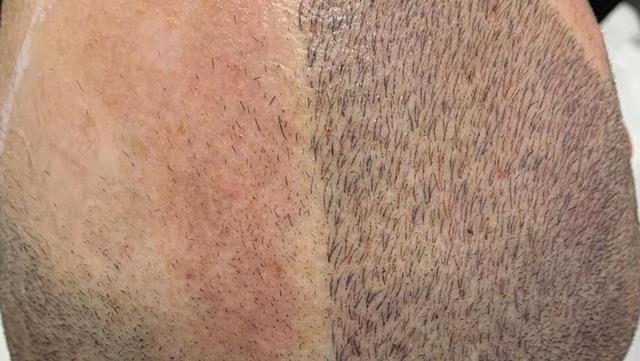 notícia Especialista desenvolve técnica de micropigmentação capilar que reproduz o cabelo natural