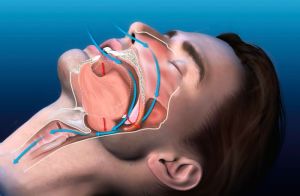 notícia Ronco e apneia: desvendando os mitos sobre tratamentos naturais