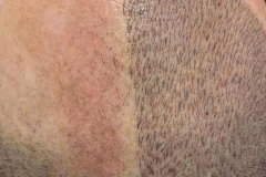 noticia Especialista desenvolve técnica de micropigmentação capilar que reproduz o cabelo natural