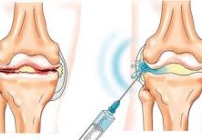 noticia Tratamento da artrose do joelho sem cirurgia