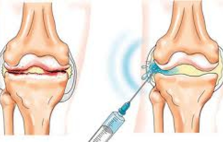 noticia Tratamento da artrose do joelho sem cirurgia