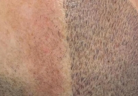 noticia Especialista desenvolve técnica de micropigmentação capilar que reproduz o cabelo natural