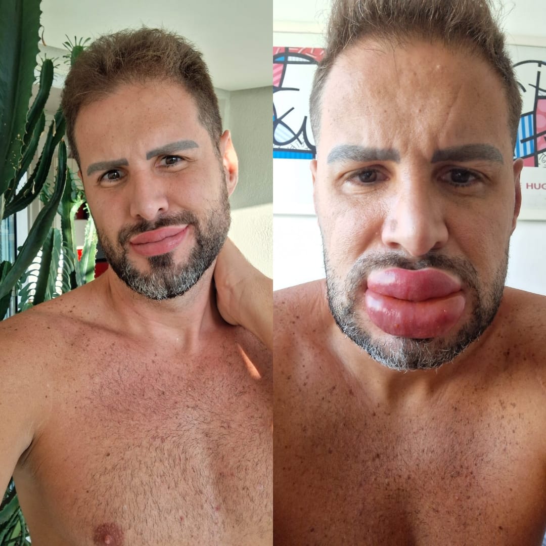 artigo Bernardo Langlott retira preenchimento labial e revela drama: 