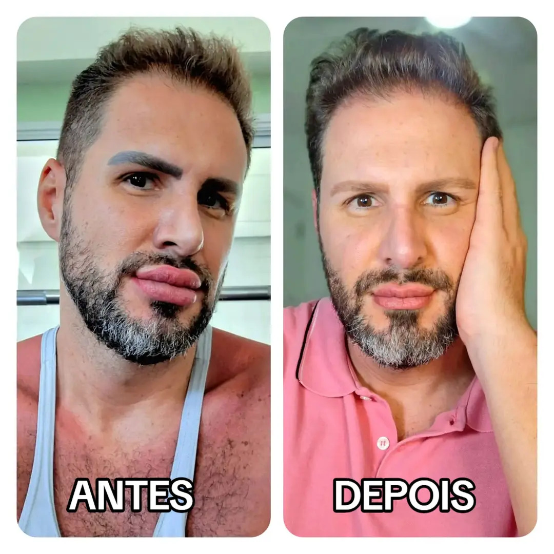 artigo Bernardo Langlott reverte procedimentos e gera debate sobre excessos na aparência: 