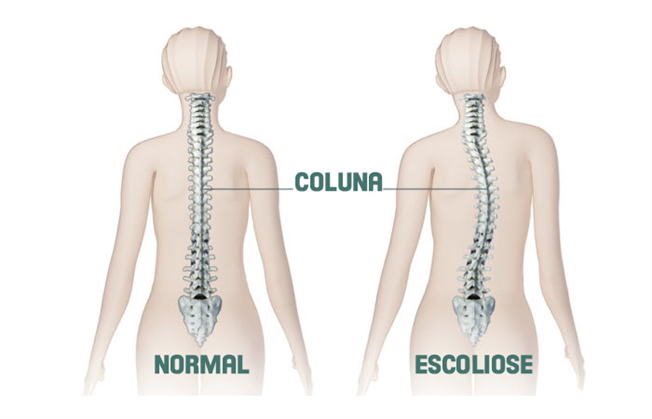 noticia Tenho escoliose, o que fazer agora? 