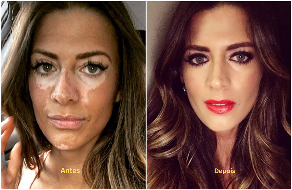 noticia Empresária investe em maquiagem que valoriza a beleza de mulheres com vitiligo