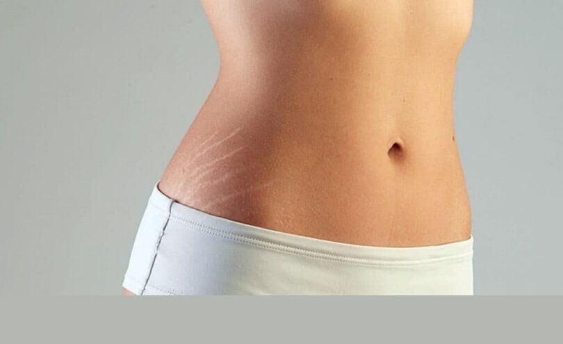 noticia Conheça os tipos de estrias e os tratamentos para cada caso