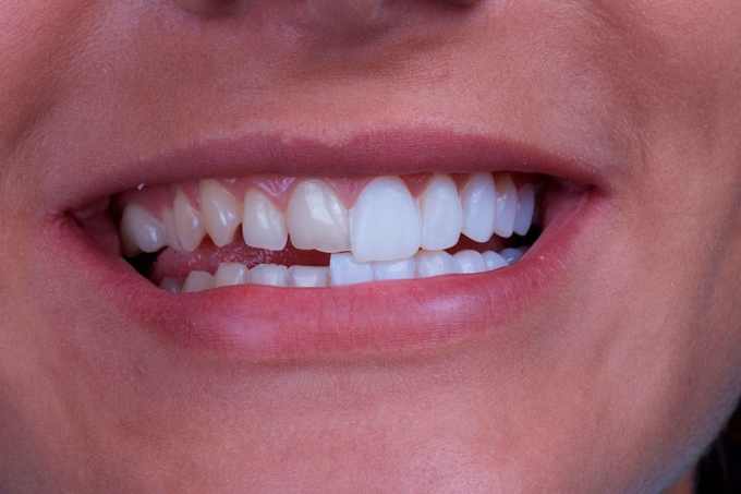 noticia Facetas dentais: o que são e para que servem?