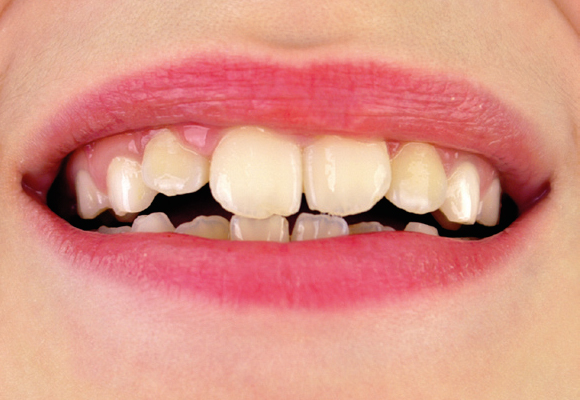 noticia Dentes afastados ou mordida desigual? Pode ser maloclusão