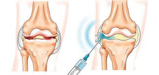 noticia Tratamento da artrose do joelho sem cirurgia