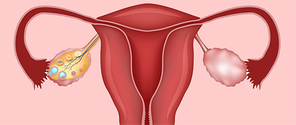 noticia Óvulos policísticos é uma das principais causas de infertilidade feminina