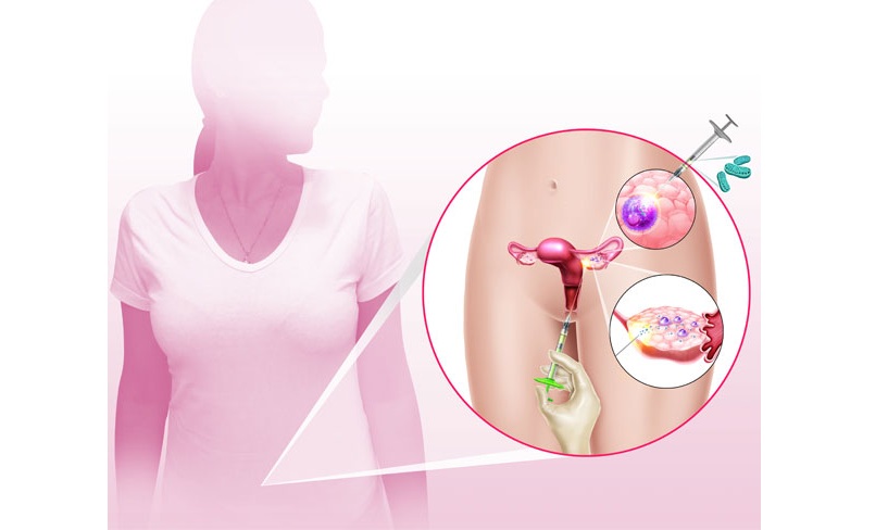 noticia Nova técnica para rejuvenescimento de ovário é uma alternativa para mulheres com menopausa precoce que desejam engravidar