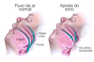 noticia Apneia do sono: uma ameaça silenciosa à saúde